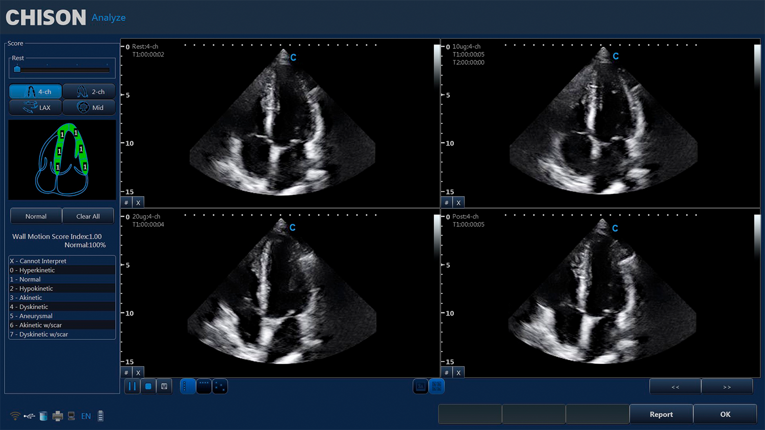 CBit 4 Stress Echo